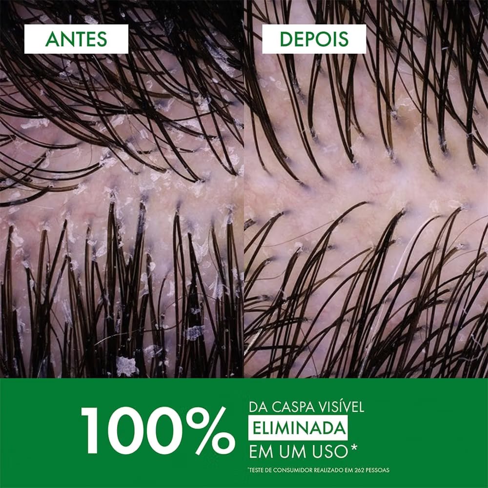 🛍 Vichy Dercos DS Shampoo Anticaspa para Cabelos Normais a Oleosos, 300ml
